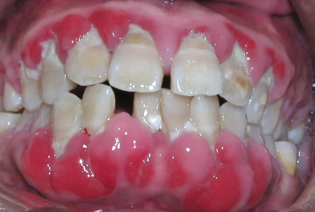 牙龈出血区分白血病图片