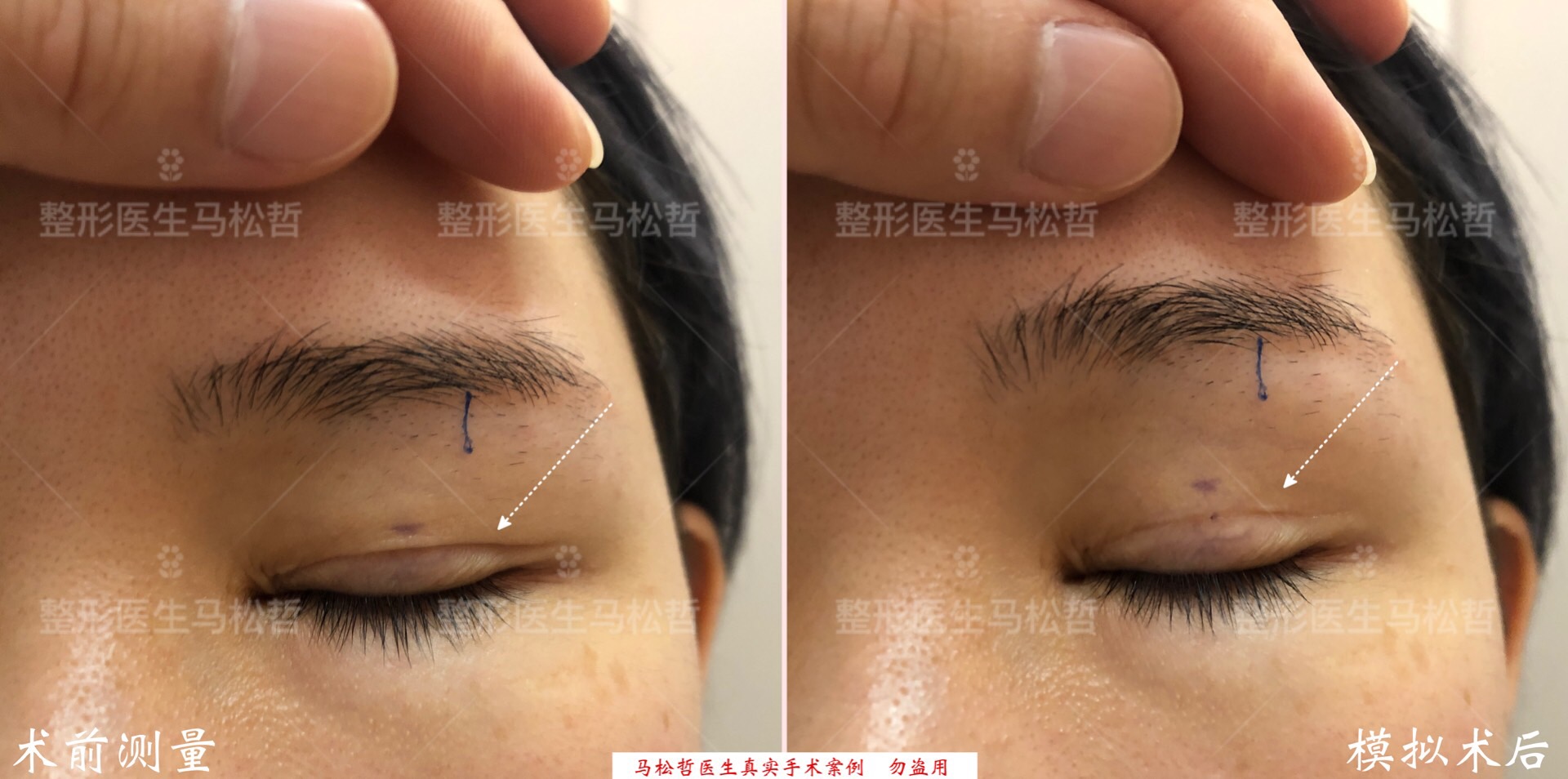 因为双眼皮的切口相对眉下提升的切口而言,不能去除太多松弛的皮肤
