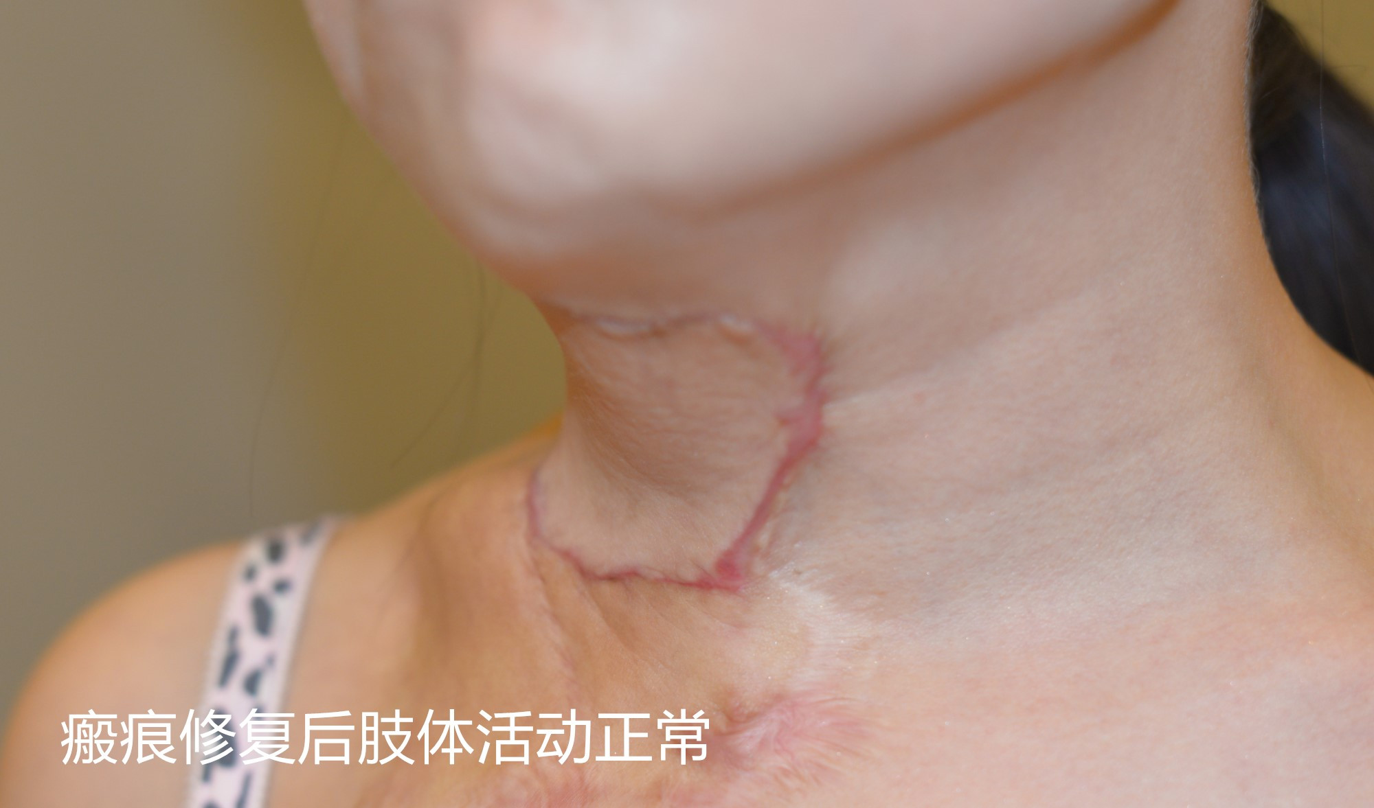 颈部疤痕扩张器效果图片