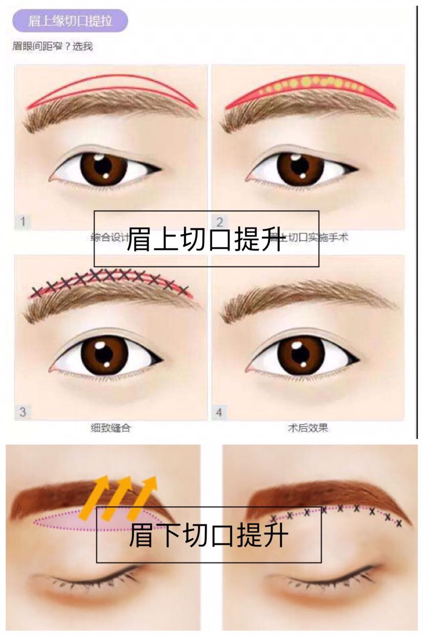 眉部整形有什么优势 刘庭华 爱问医生