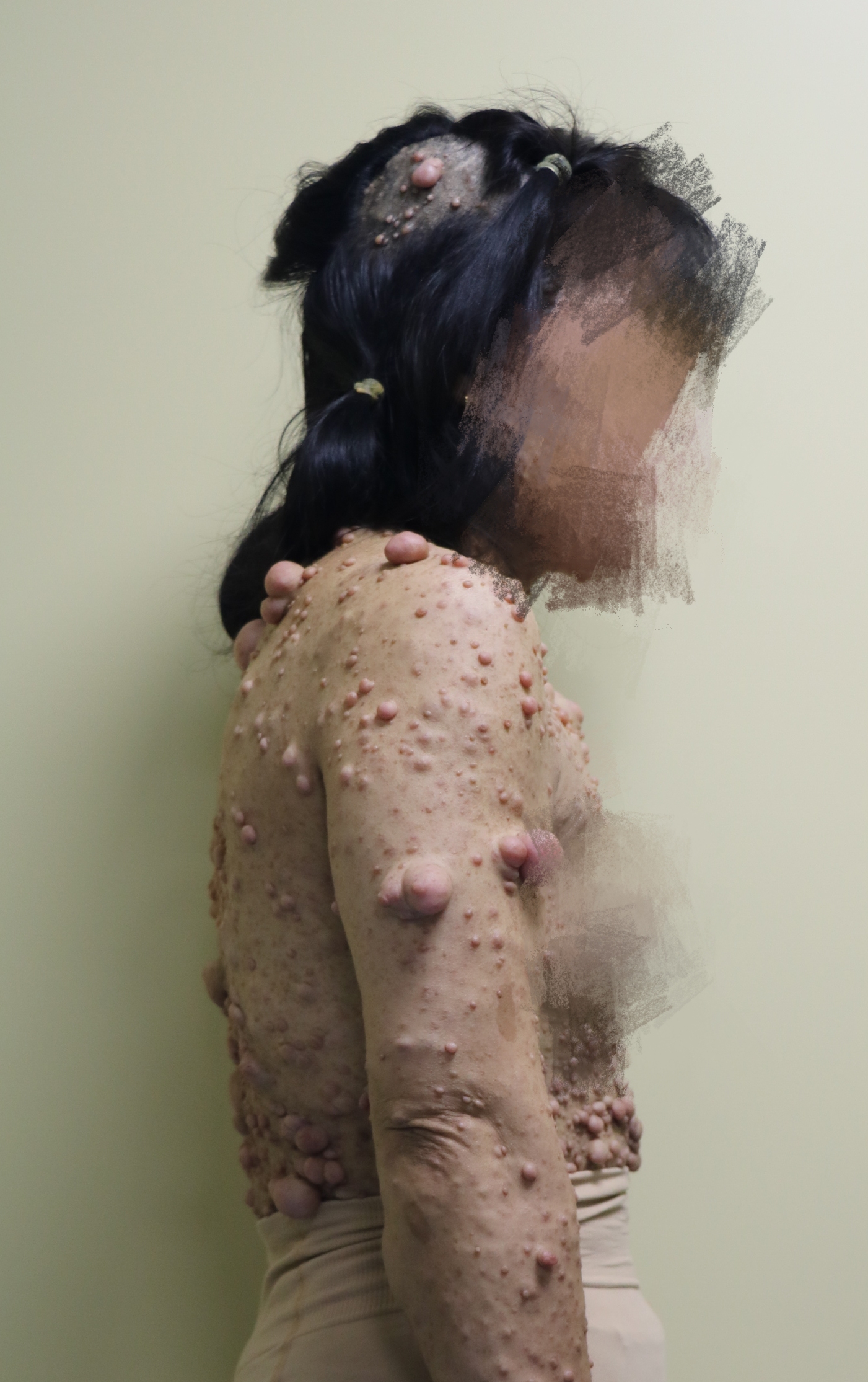 皮肤纤维瘤早期图片图片