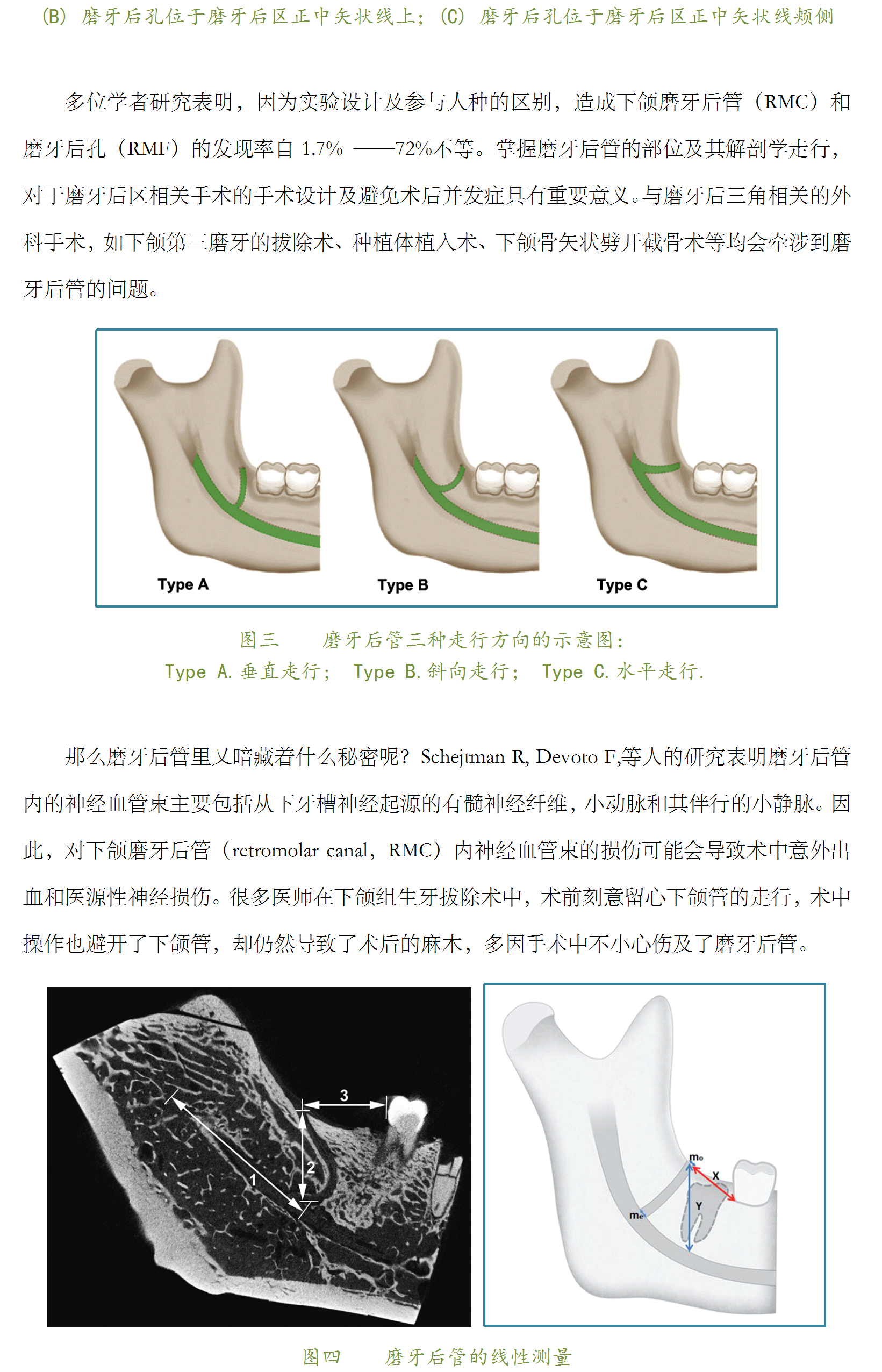 磨牙后区的隐形杀手——下颌磨牙后管