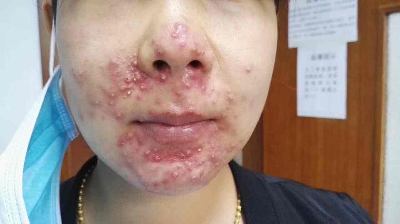 局部清洗:应注意清水洗脸,去除皮肤表面的油脂及皮屑和细菌的混合物