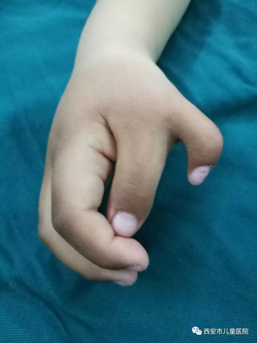 治疗多指(趾)畸形,什么时候手术最佳?-朱伟主任医师-爱问医生