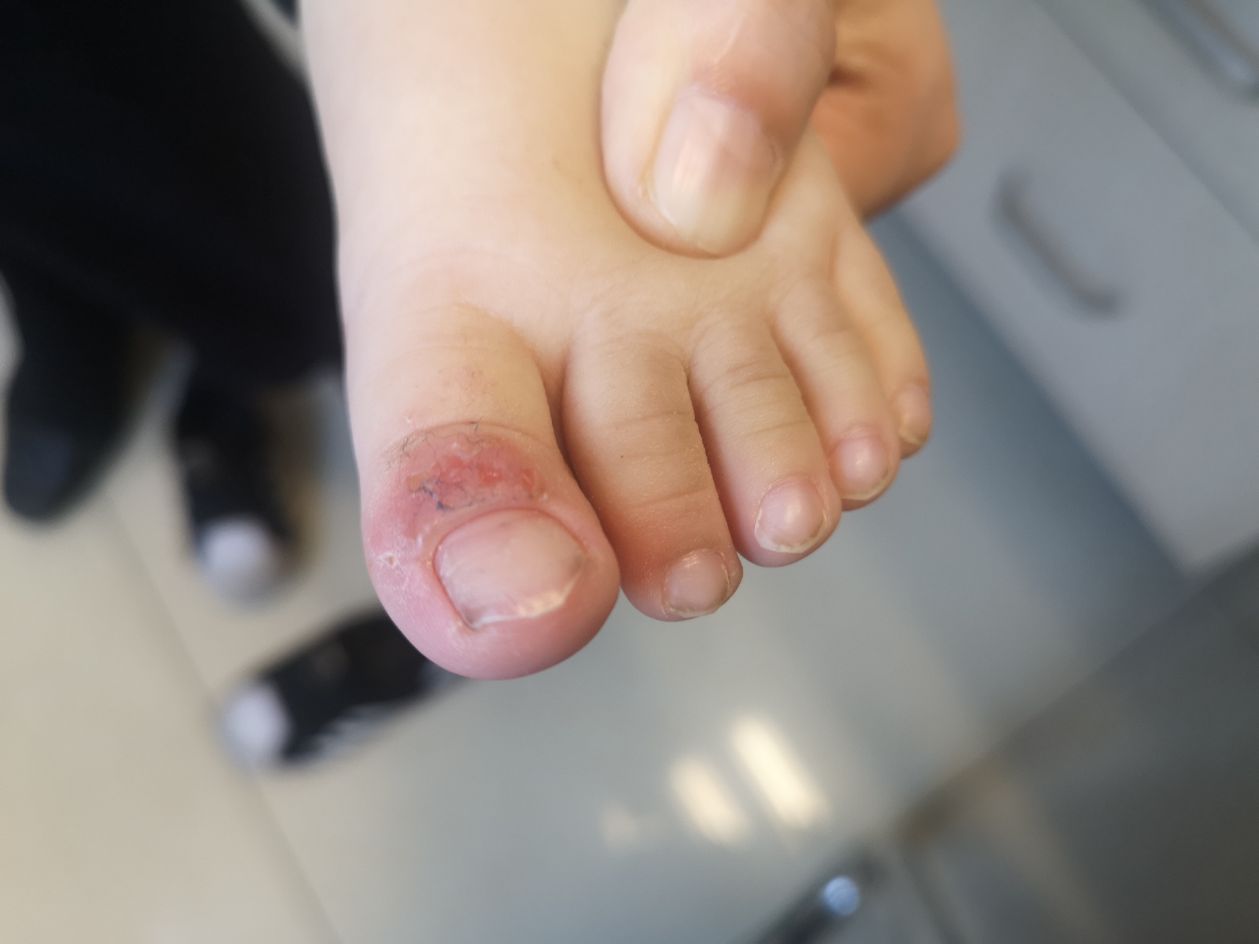 脚趾头恶性肿瘤的图片,脚趾癌 - 伤感说说吧