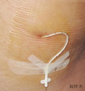 在腹部外科,术中放在肚子里的管子叫腹腔引流管.