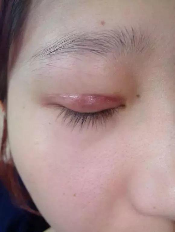双眼皮消肿快与慢,与这几件事情做得好坏有直接的关系
