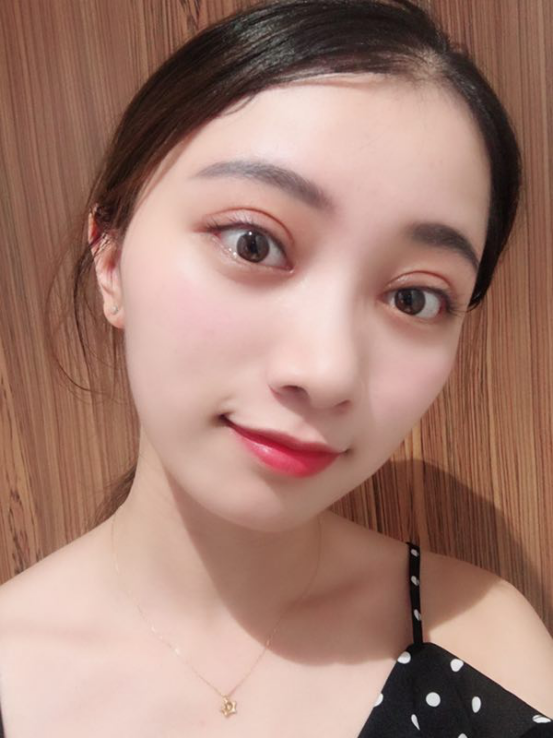 天生的双眼皮,还要做双眼皮手术?