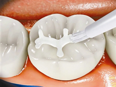 窝沟封闭的那些事