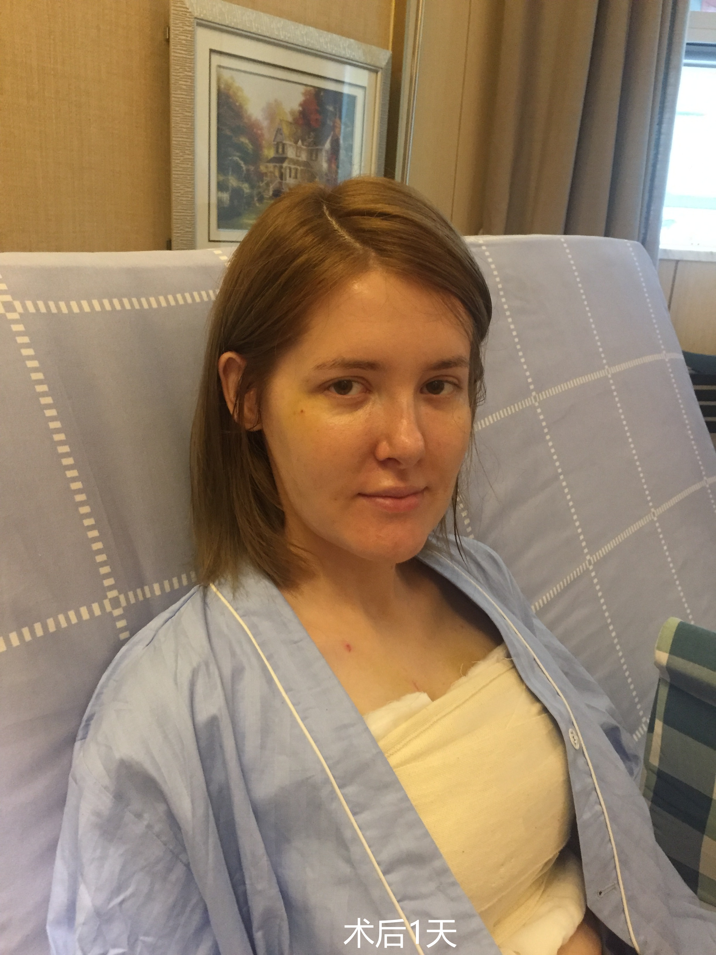 隆胸手术后的照片图片