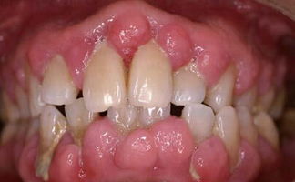 牙周组织的炎症较重,龈缘红肿可呈肉芽状增生,易出血,常有牙周袋溢脓