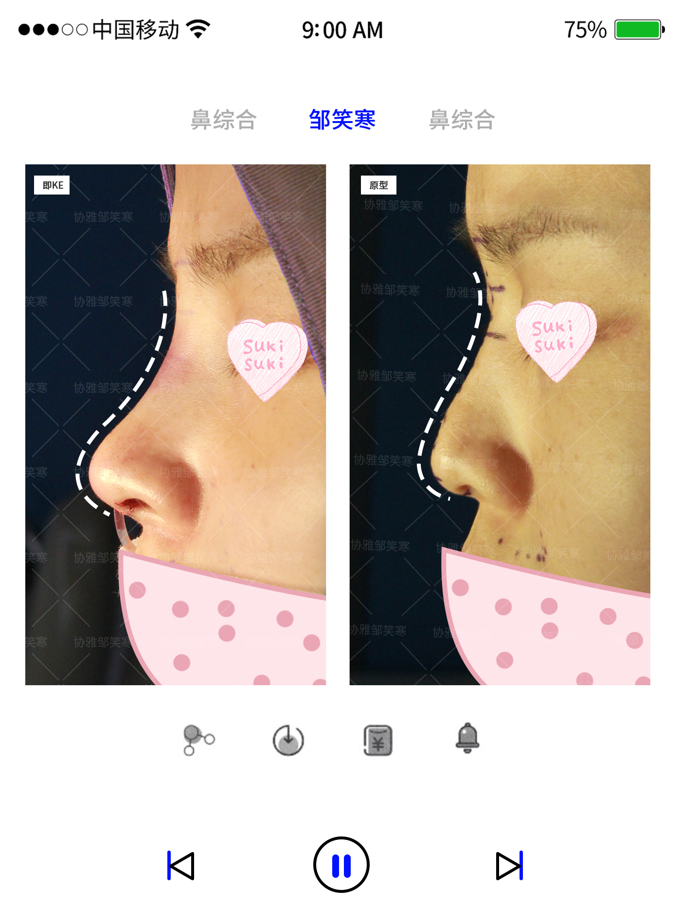 用玻尿suan填充山根 真的可以让鼻子变挺吗 邹笑寒 爱问医生