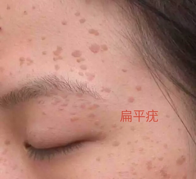 一句话科普:今天一起来认识《疣》,俗称"瘊子""千日疮""枯筋箭".