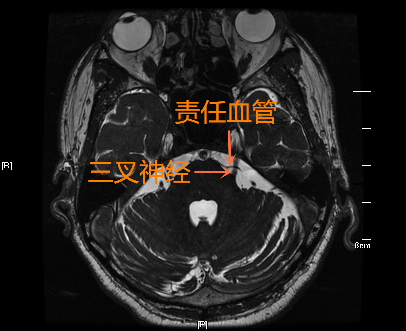 三叉神经磁共振图像图片