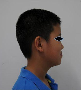 在儿童生长发育过程中,如果前牙反合(图1)不及时治疗则下牙弓限制了前