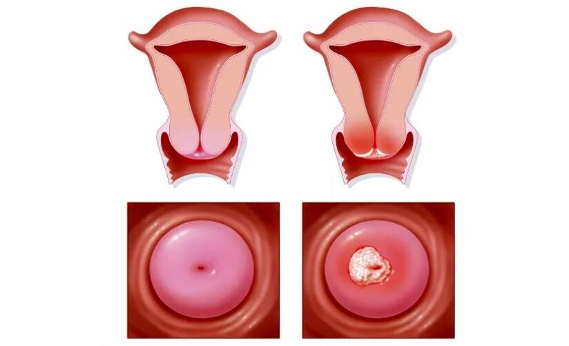 宮頸菜花狀是什麼病
