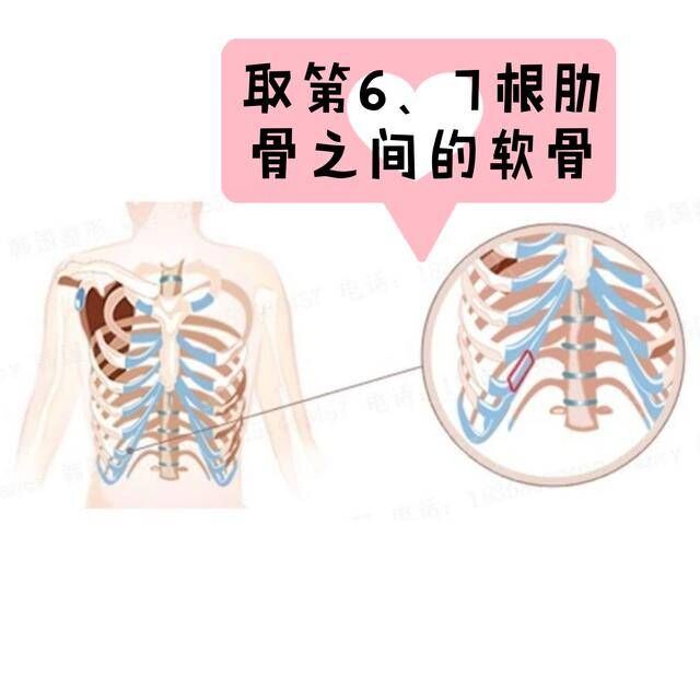 隆鼻取自体肋软骨到底有多可怕 徐荣阳副主任医师 爱问医生