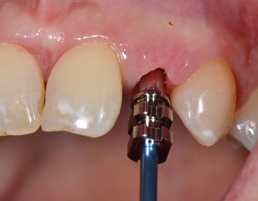 上颌侧切牙缺失后正畸 种植修复案例