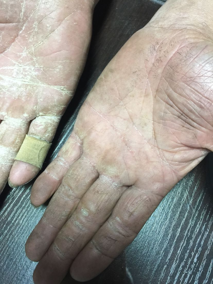 双手皮肤粗糙皲裂要排除鹅掌风