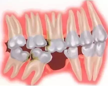导致部分甚至全部被占据,以致恒牙错位萌出或埋伏阻生而形成牙颌畸形