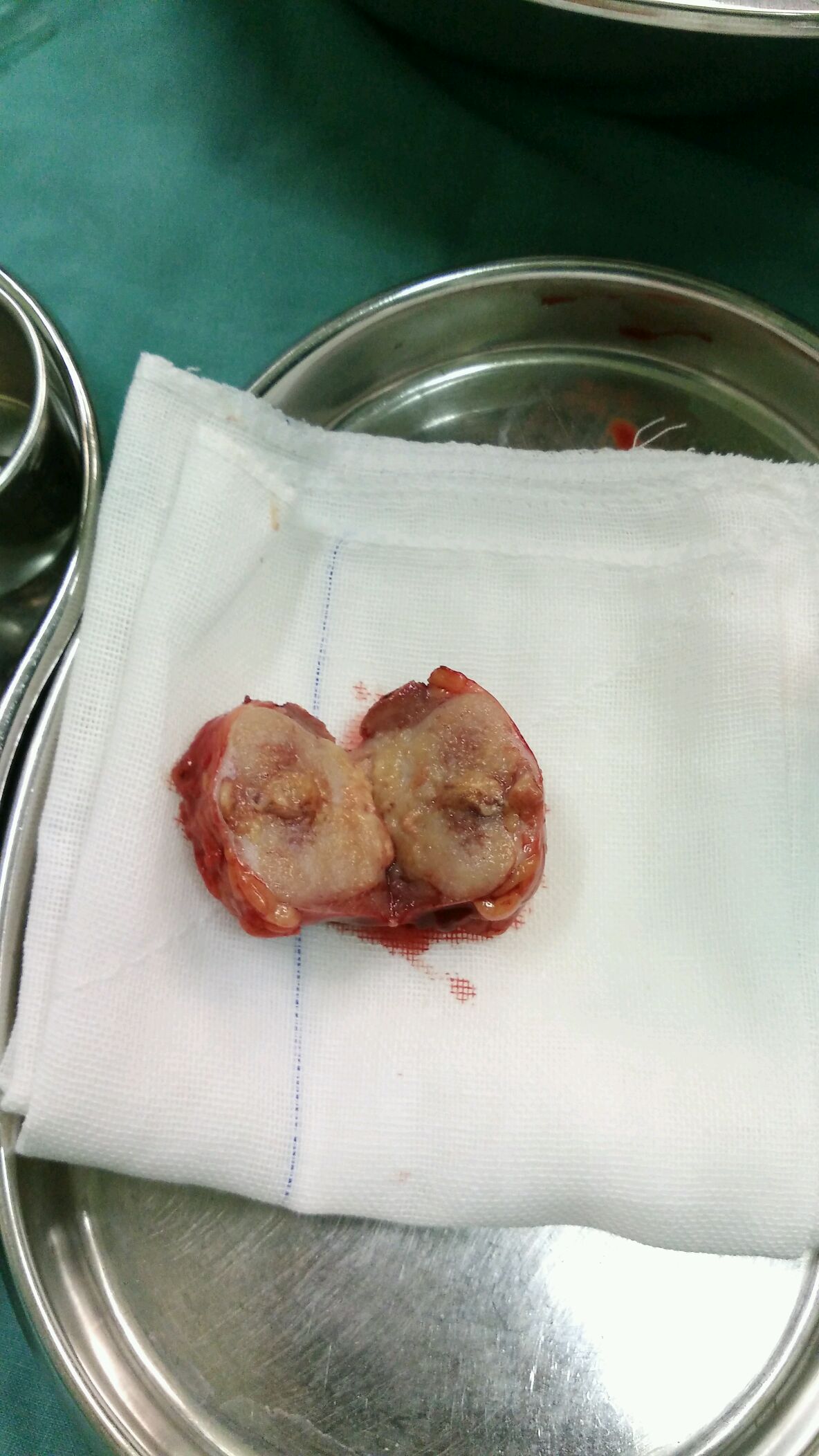 右肾癌开放右肾部分切除术20161208诊间日记