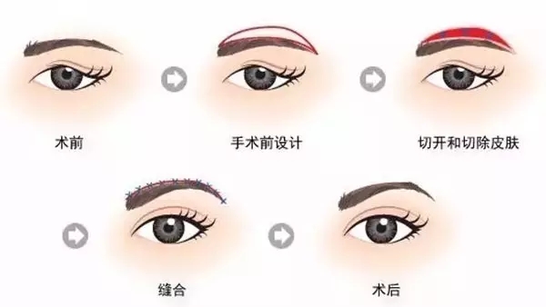 悬眉是将眉毛及周围的皮肤部分切除或将眉毛全部切除的一种美容手术