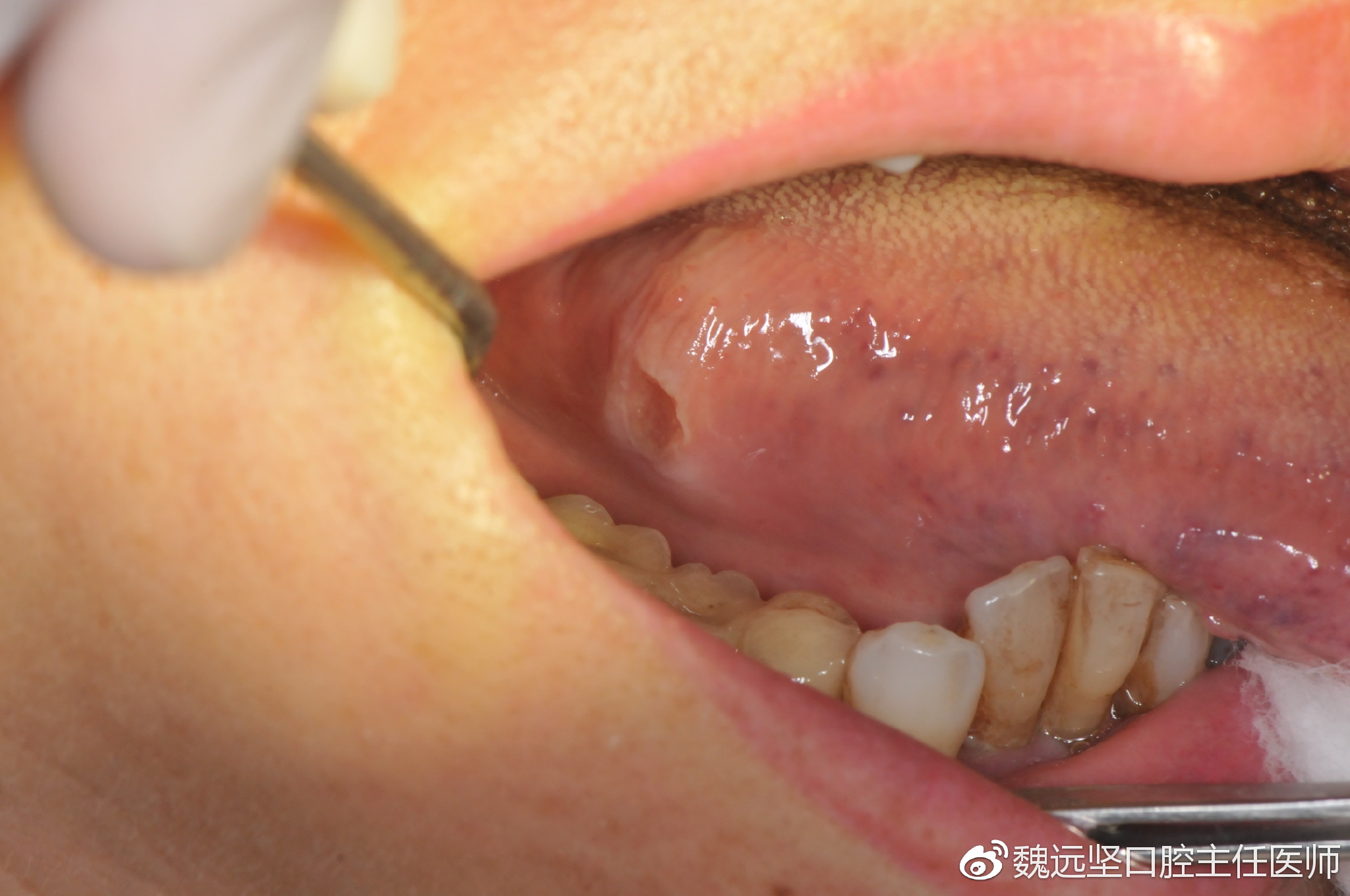 将舌体往外及对侧牵拉,一看吓一跳!