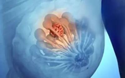 胀,肿,痛……如何摆脱乳腺增生的苦恼,拯救乳房?