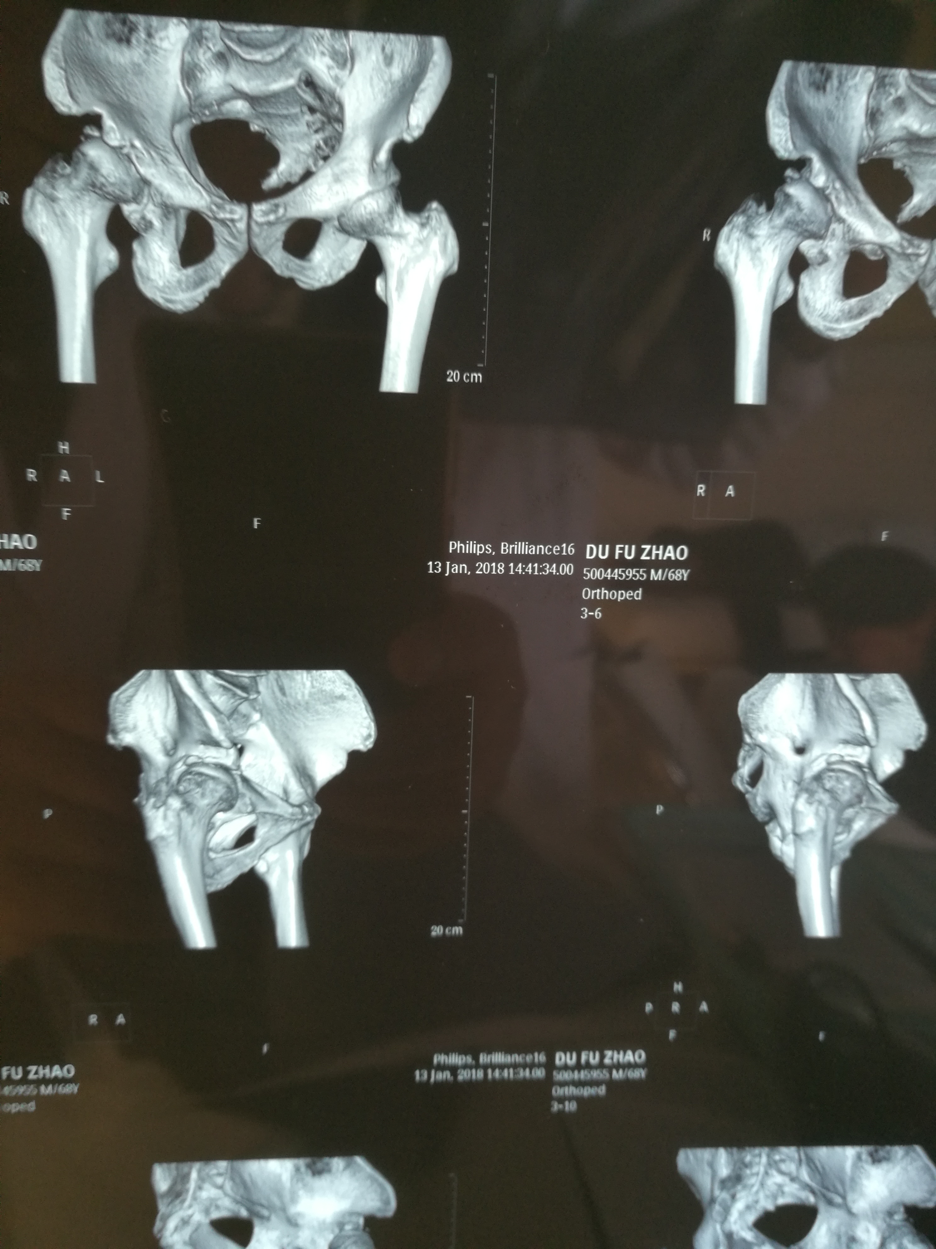 一例髋臼畸形,股骨头硬化性坏死合并腰椎间突出症的患者-孟繁春-爱问
