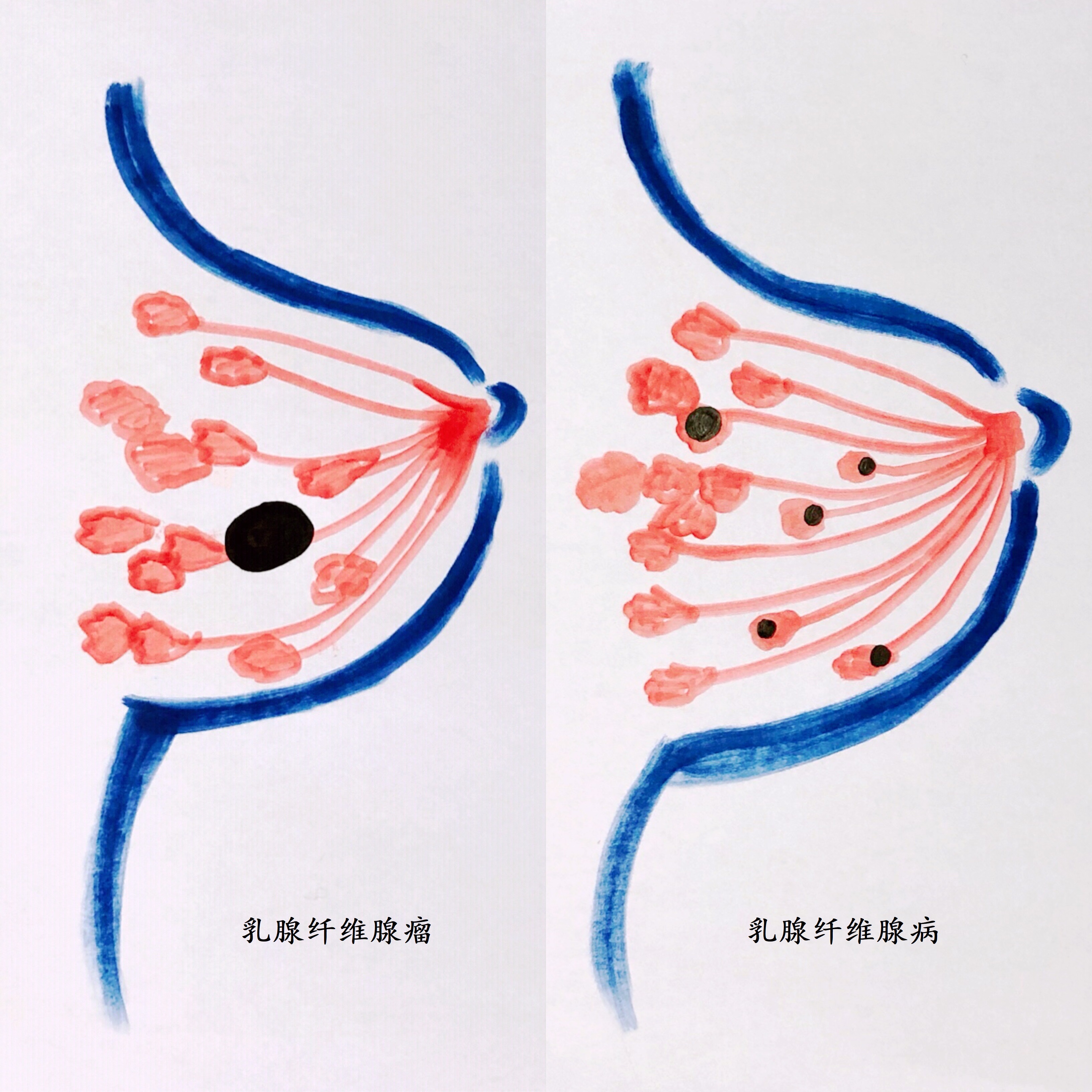 乳腺纖維腺瘤=乳腺纖維腺病?