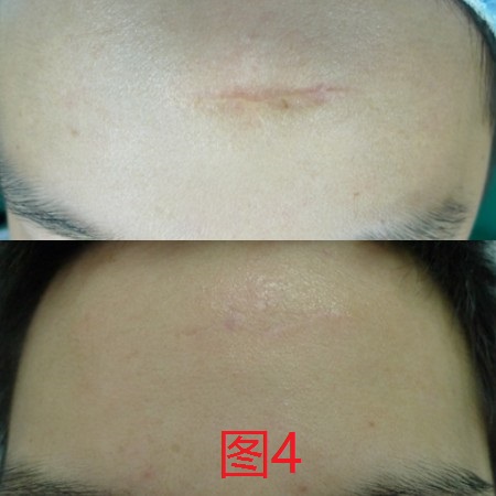 保留部分疤痕真皮的疤痕切除缝合术