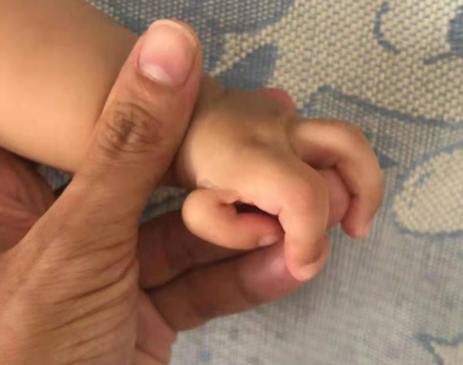 宝宝吃手会不会导致漂浮拇指更加畸形会不会把漂浮拇指弄掉