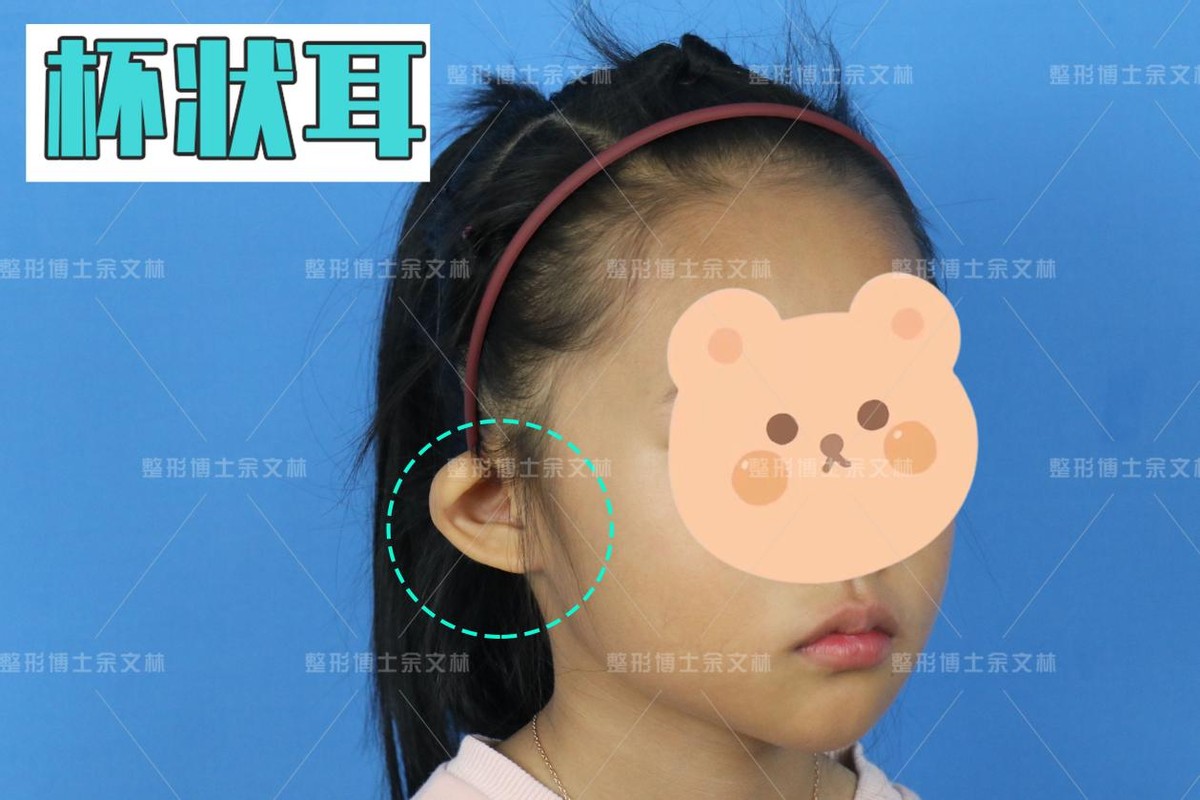 杯状耳 折耳猫可爱 如果人的耳朵也长这样还会可爱吗 余文林 爱问医生