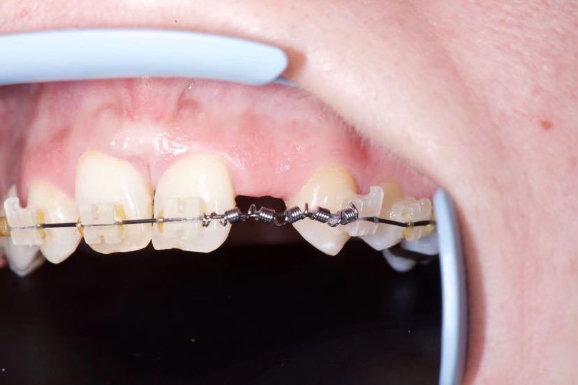 上颌侧切牙缺失后正畸 种植修复案例