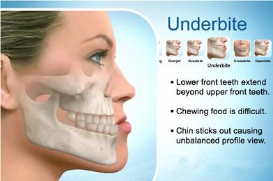 有上下牙弓的协调关系而过度向前发育,这样形成颜面中三分之一的凹陷