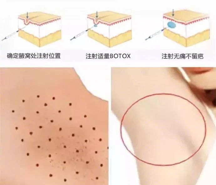 打完肉毒素面瘫了女人为什么对自己这么狠