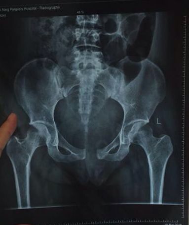 对耻骨联合分离症的认识和一些基本对策