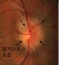 科普丨高血压需重视,警惕眼部并发症找上门