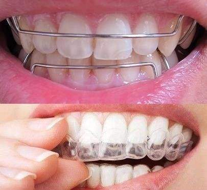 牙齿保持器一般戴多久图片