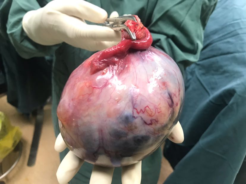 诊间日记双侧卵巢浆液性囊腺癌