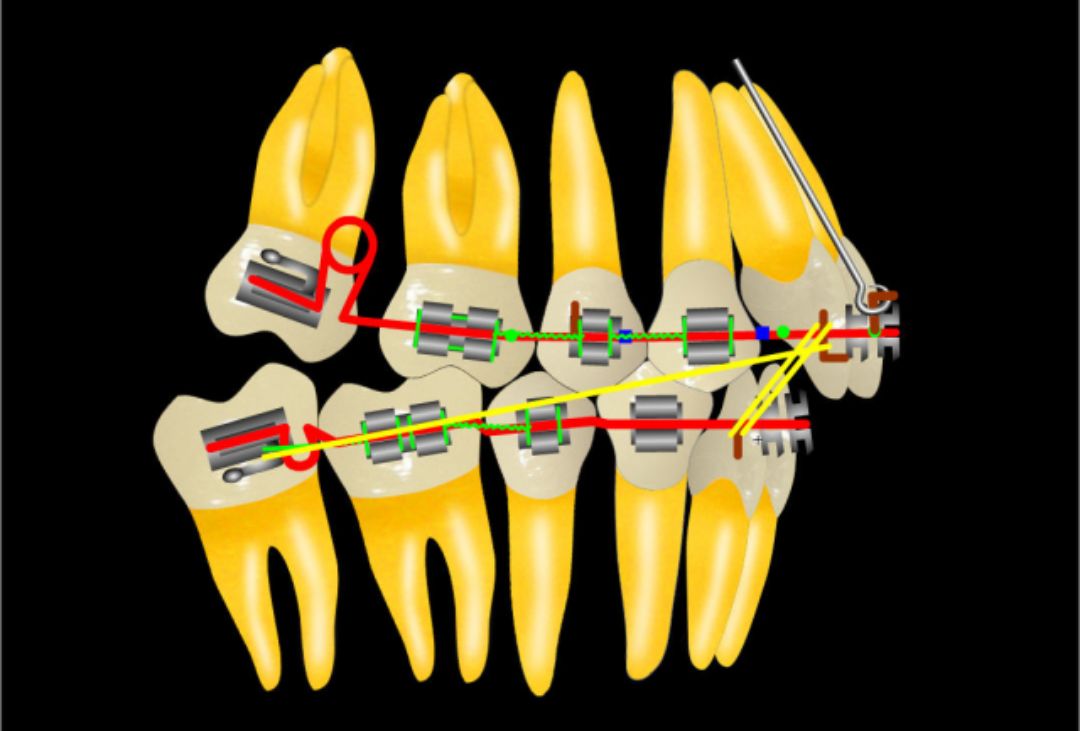 牙齿矫正:矫正间隙的获得
