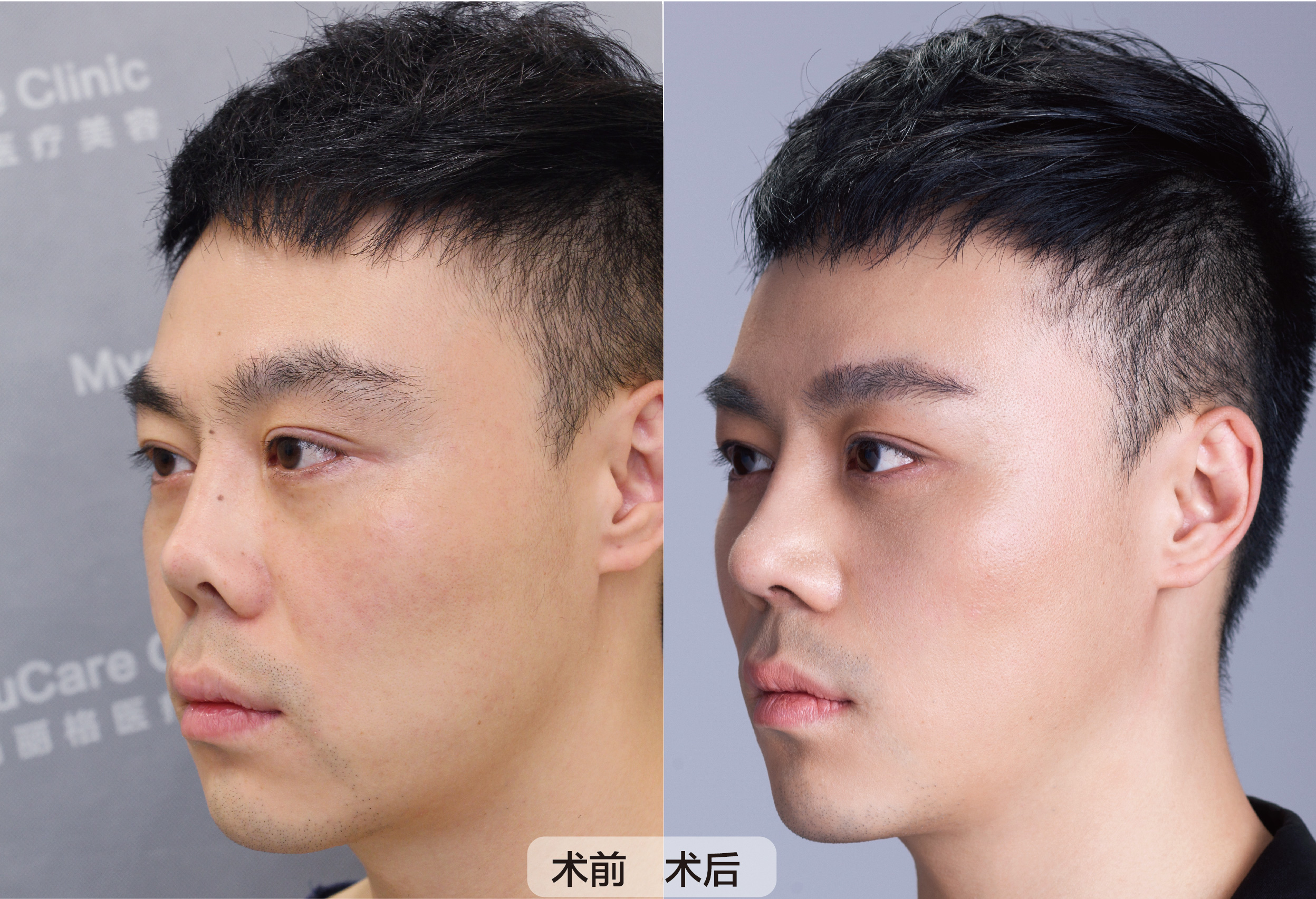 为什么越来越多的男性隆鼻