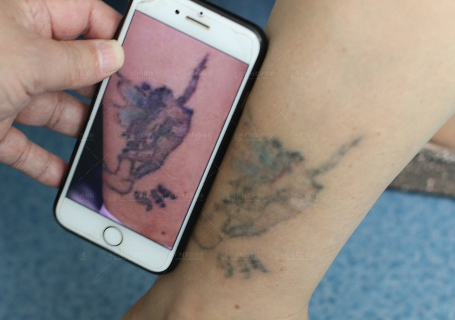 我爱罗纹身皮秒洗纹身效果对比案例 - 皮秒激光洗纹身案例 武汉老兵纹身