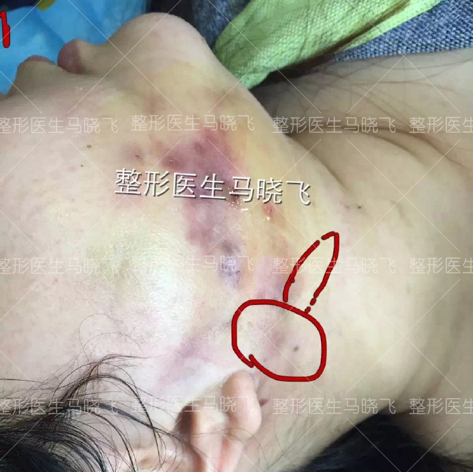5月三次脂肪液化处理前6月脂肪液化处理前…………不远千里寄锦旗 道