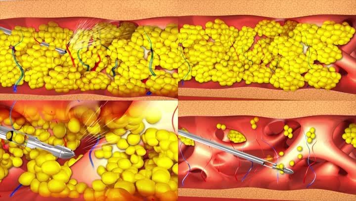 超重也不见得能进行吸脂手术
