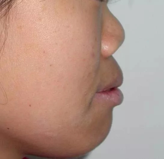 也称binder综合征,即上颌鼻发育不全,它以中面部及鼻发育不良为主要