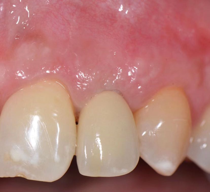 上颌侧切牙缺失后正畸 种植修复案例-薛启明副主任医师-爱问医生