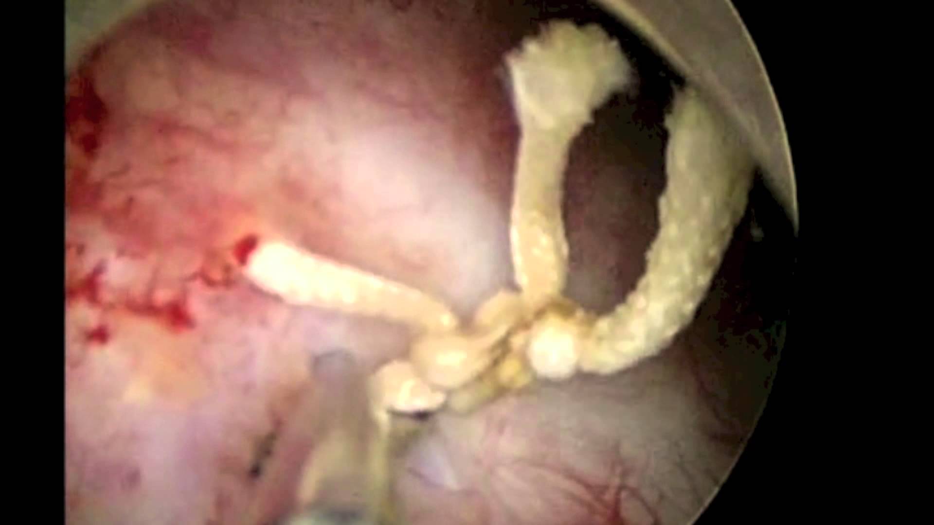 黄鳝只是受害者之一说说那些被塞入人体的异物们和阴茎被套的钢