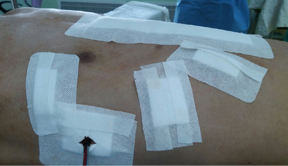 再创奇迹重度复杂胸廓畸形手术今天获得成功