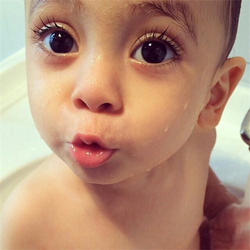 独眼患儿定期复查很重要